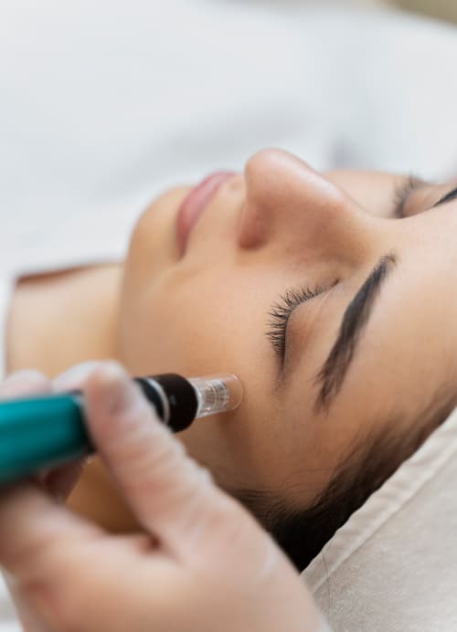 Trattamento Needling